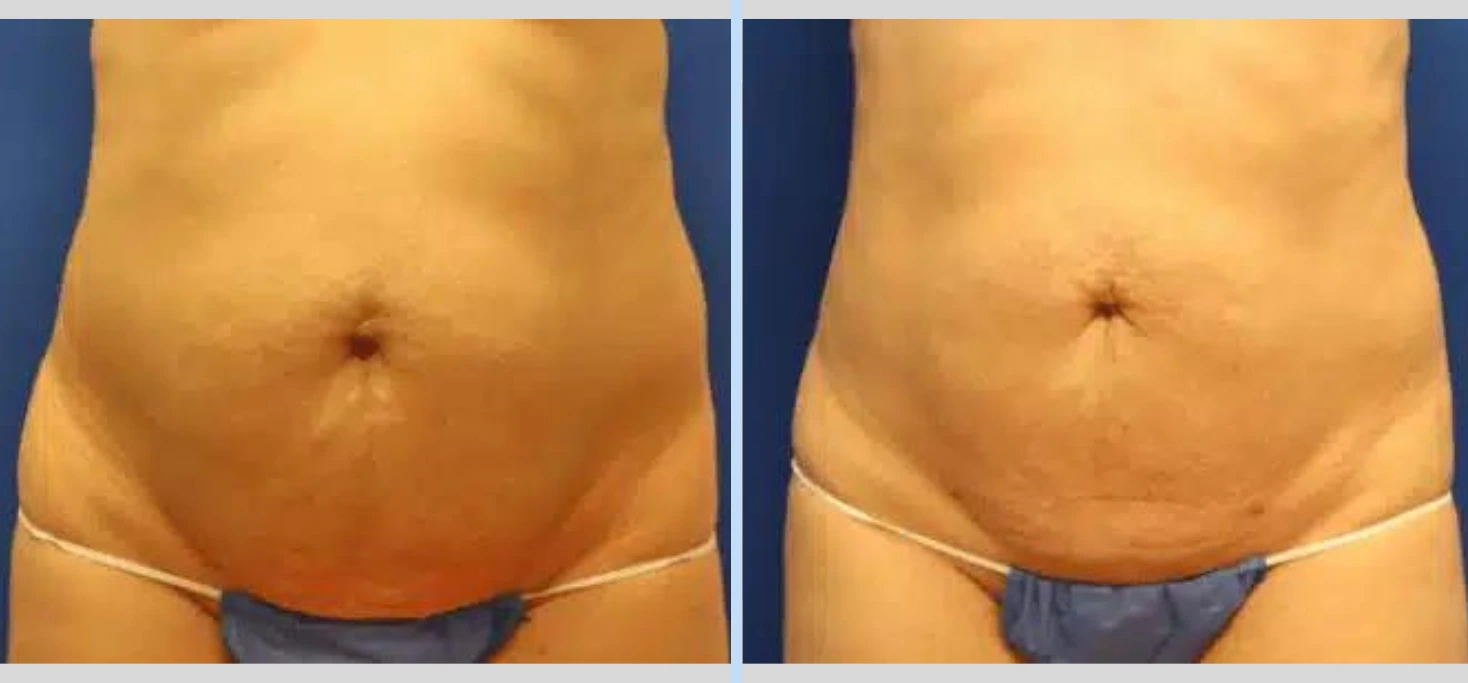 SmartLipo Before & After - Case 4 Banner