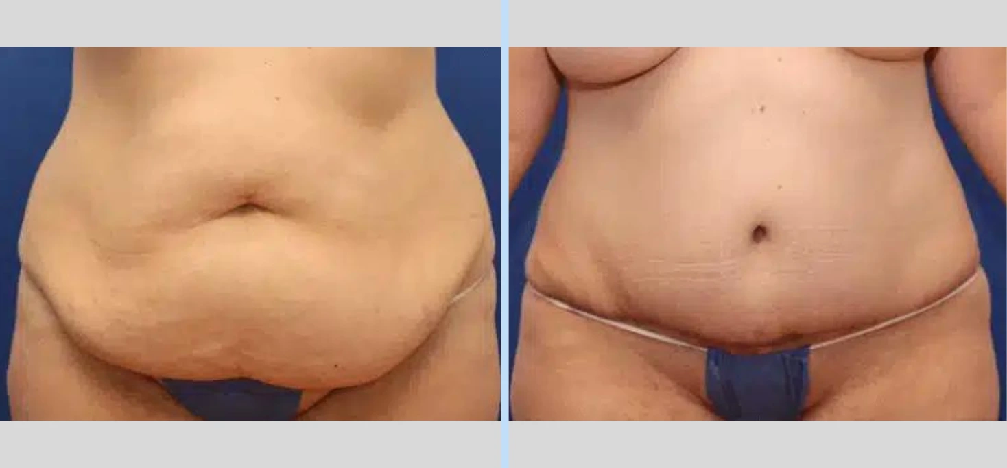 Tummy Tuck Before & After – Case 10 Banner