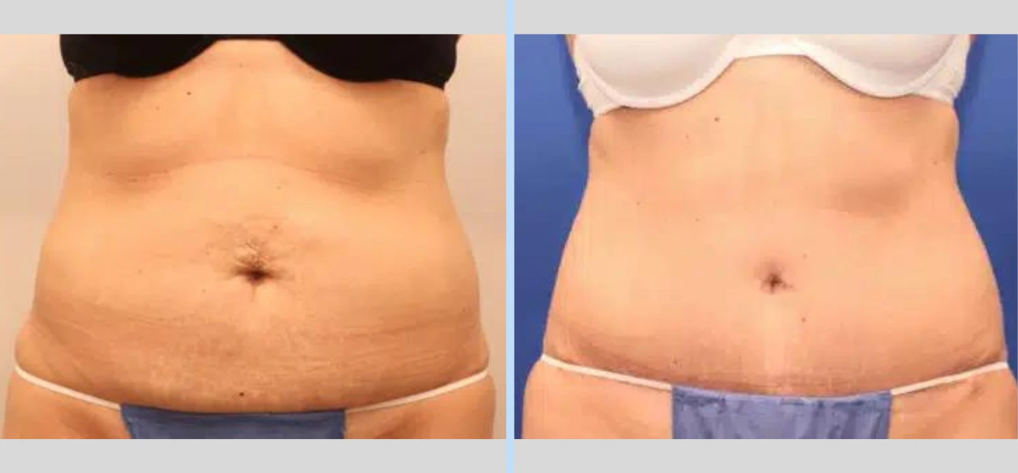 Tummy Tuck Before & After – Case 11 Banner