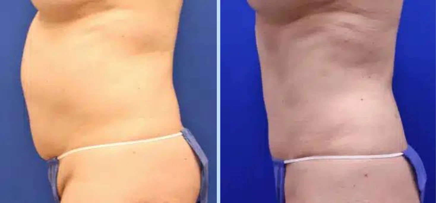 Tummy Tuck Before & After – Case 2 Banner