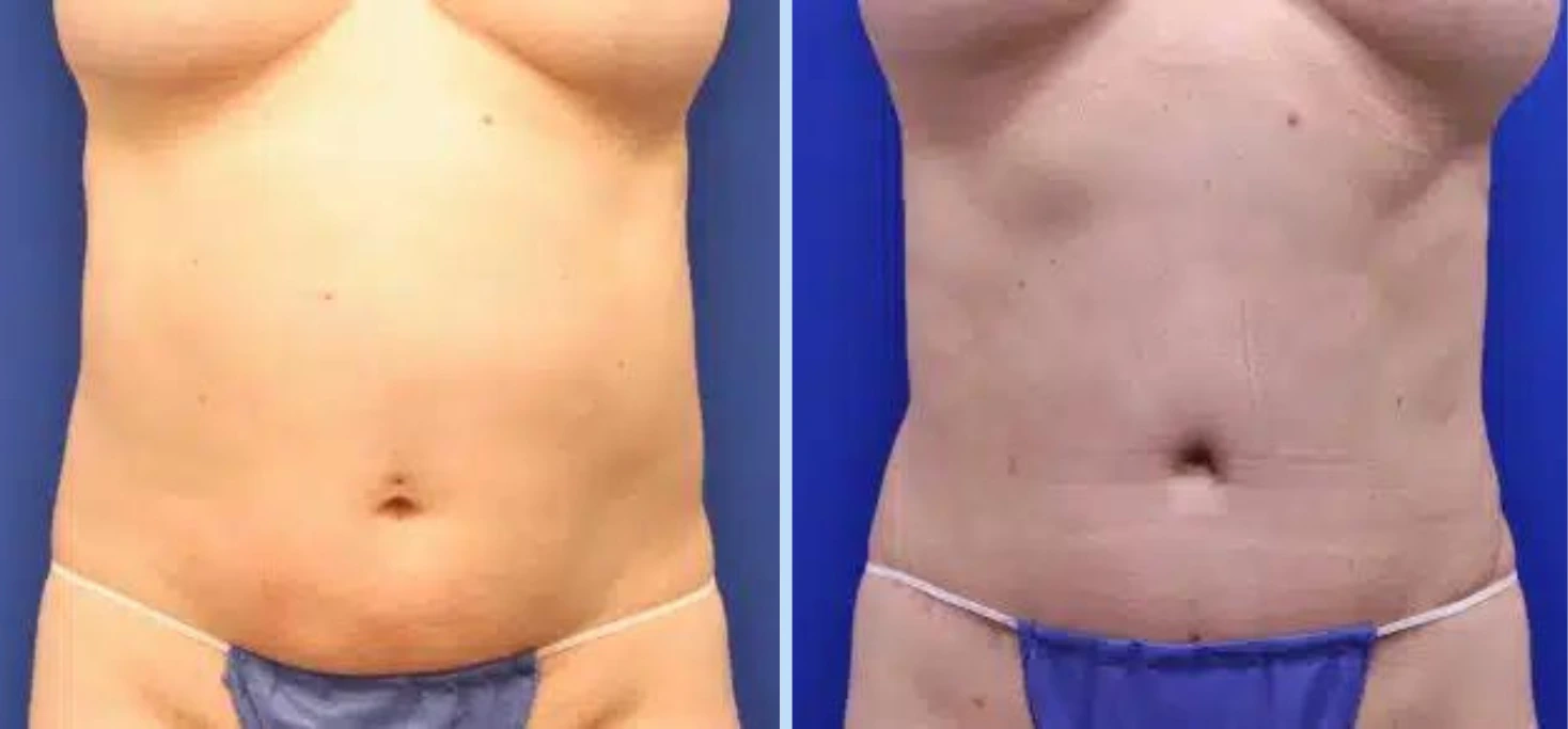 Tummy Tuck Before & After – Case 2 Banner