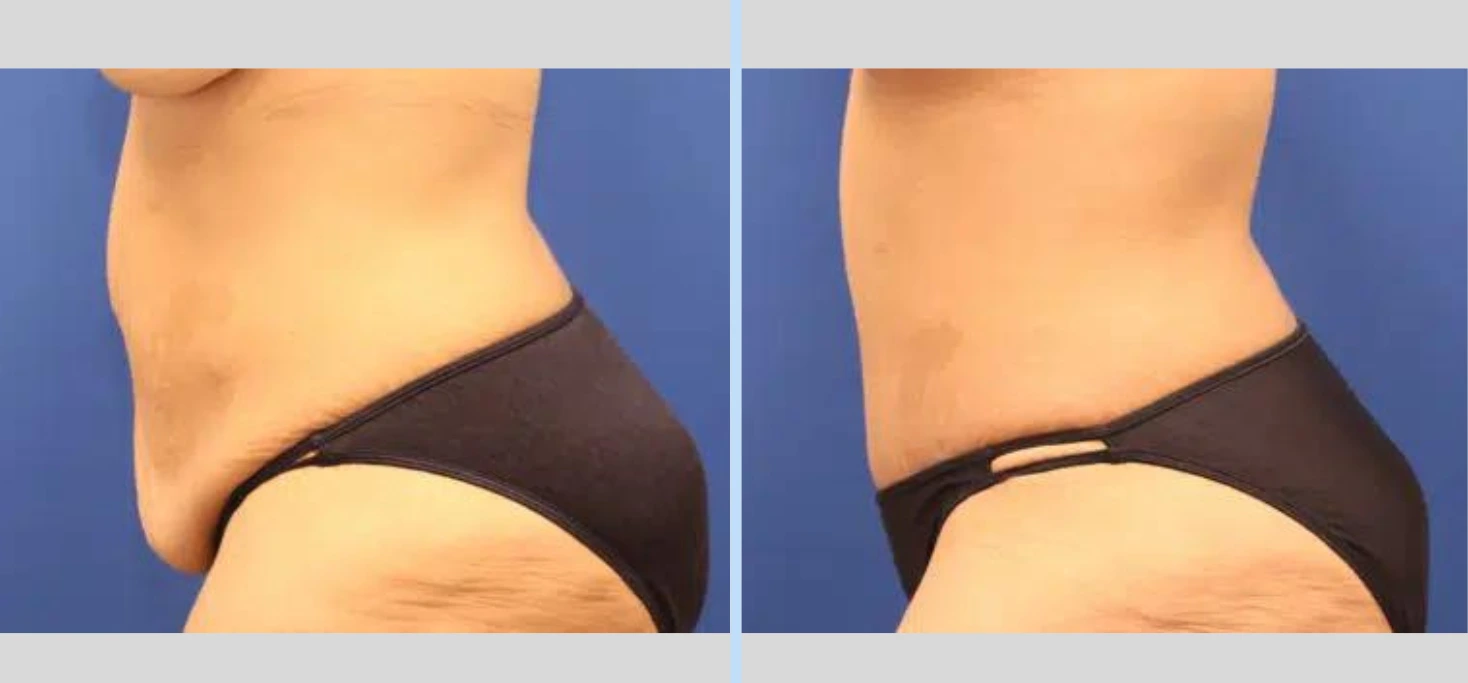 Tummy Tuck Before & After – Case 3 Banner