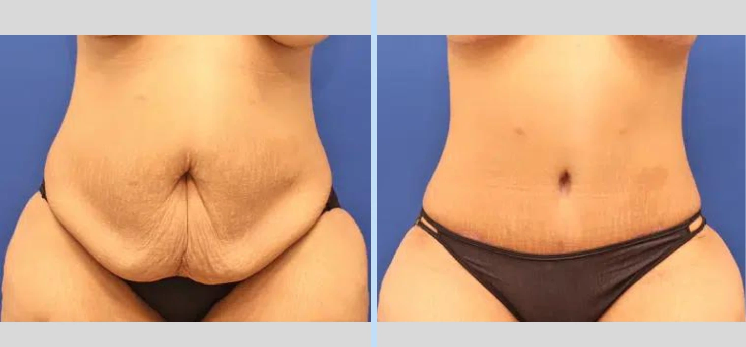 Tummy Tuck Before & After – Case 3 Banner