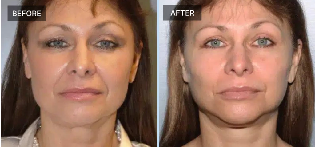 Facelift Before & After Banner