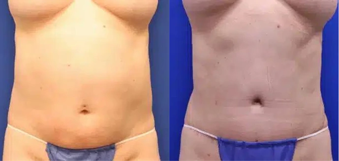 Before & After Gallery: Tummy Tuck