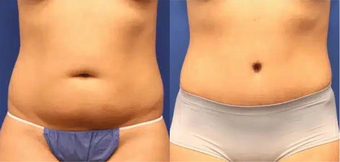Before & After Gallery: Tummy Tuck