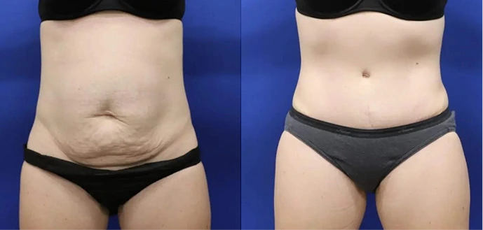 Before & After Gallery: Tummy Tuck