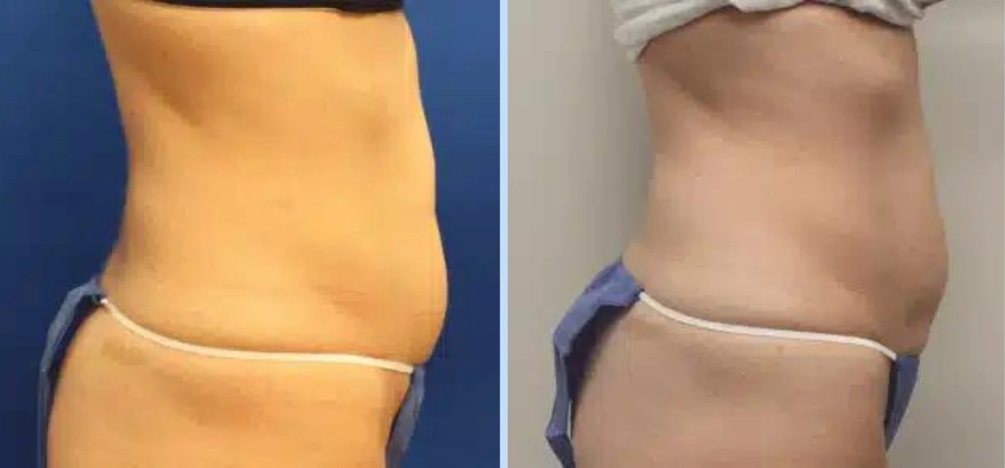 SmartLipo Before & After - Case 1 Banner
