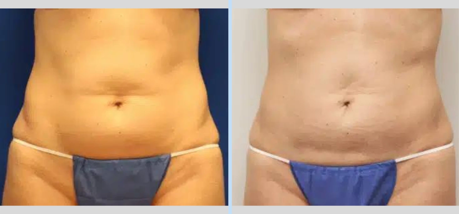 SmartLipo Before & After - Case 1 Banner