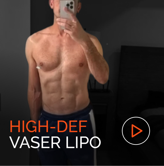 Man displaying defined abdominal muscles after vaser lipo treatment, taking mirror selfie
