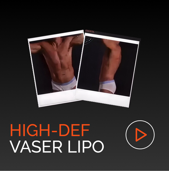 Before and after ab etching results from VASER liposuction treatment
