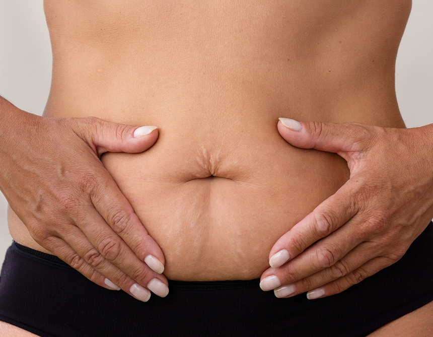 Patient's abdomen showing excess skin and tissue before extended tummy tuck surgery