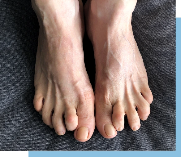 Candidates for Hammertoe Banner