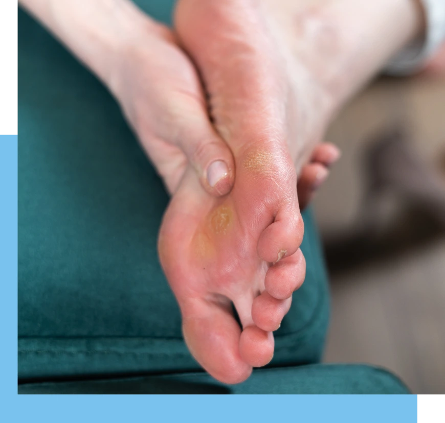 Understanding Corns and Calluses Banner