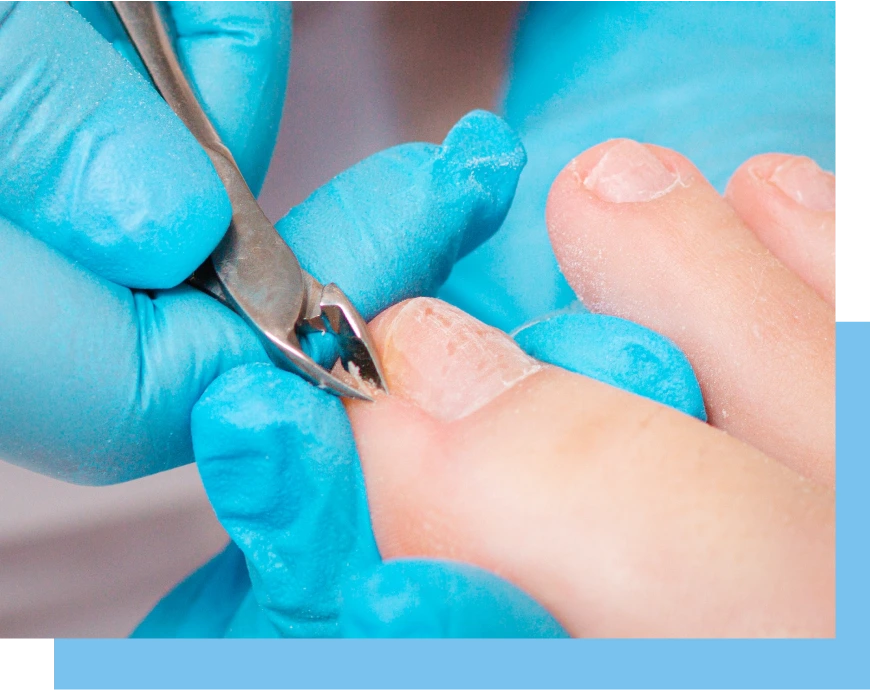 Our Treatments for Ingrown Nails in Bal Harbour, Florida Banner