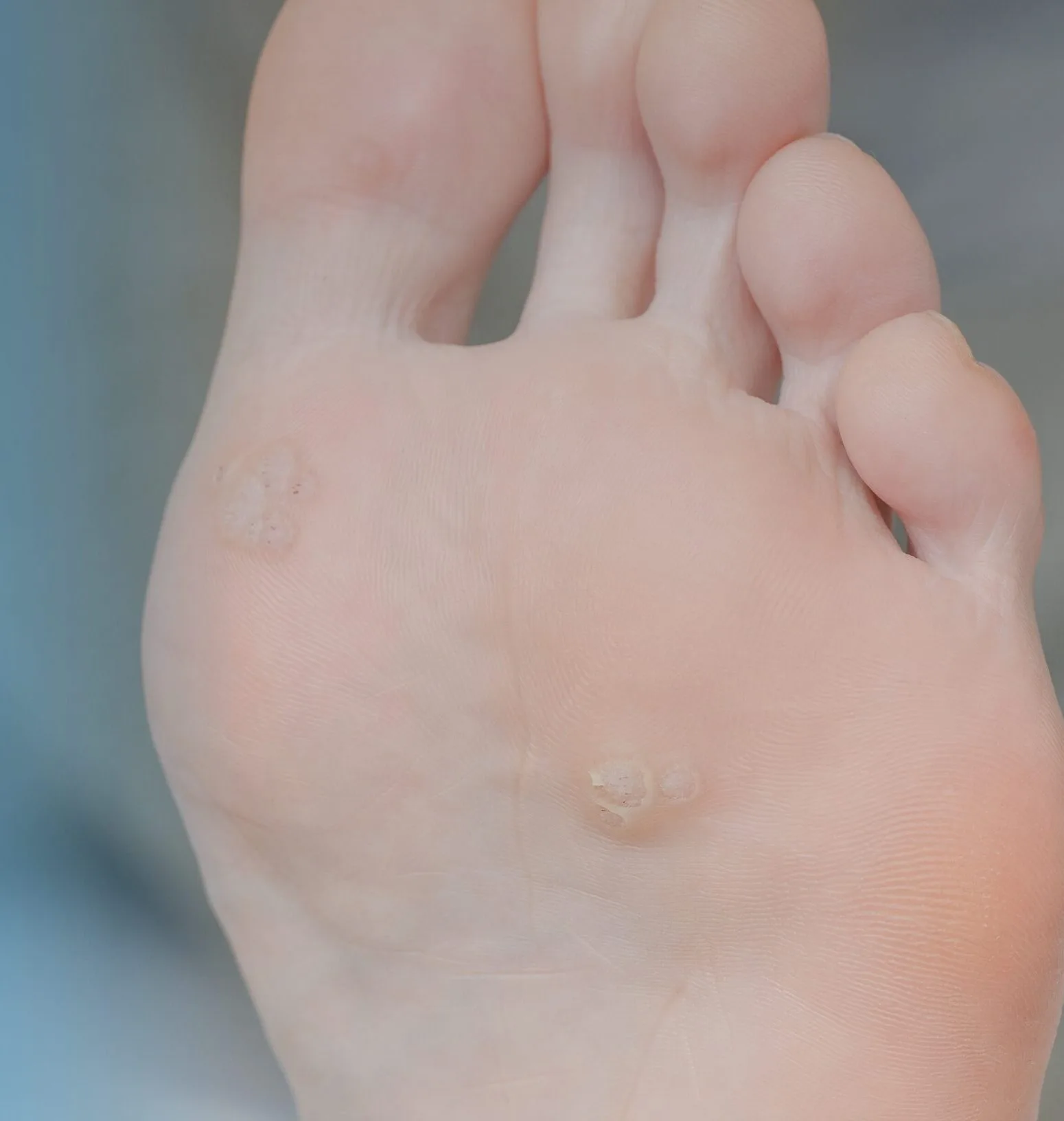 Plantar Wart Treatment Surfside, FL Banner