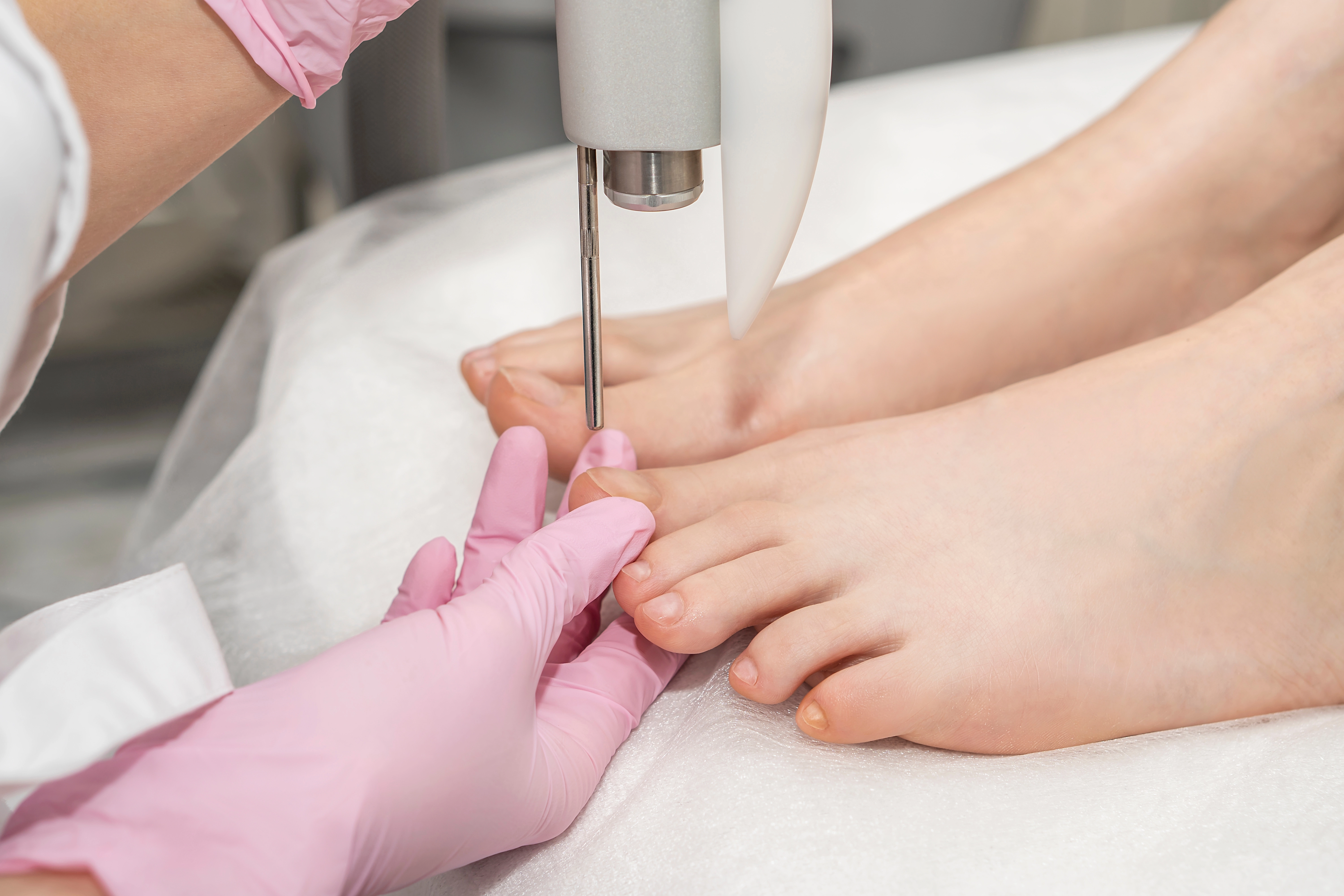Gloved clinician using a laser device on a patient's toenail during fungal treatment