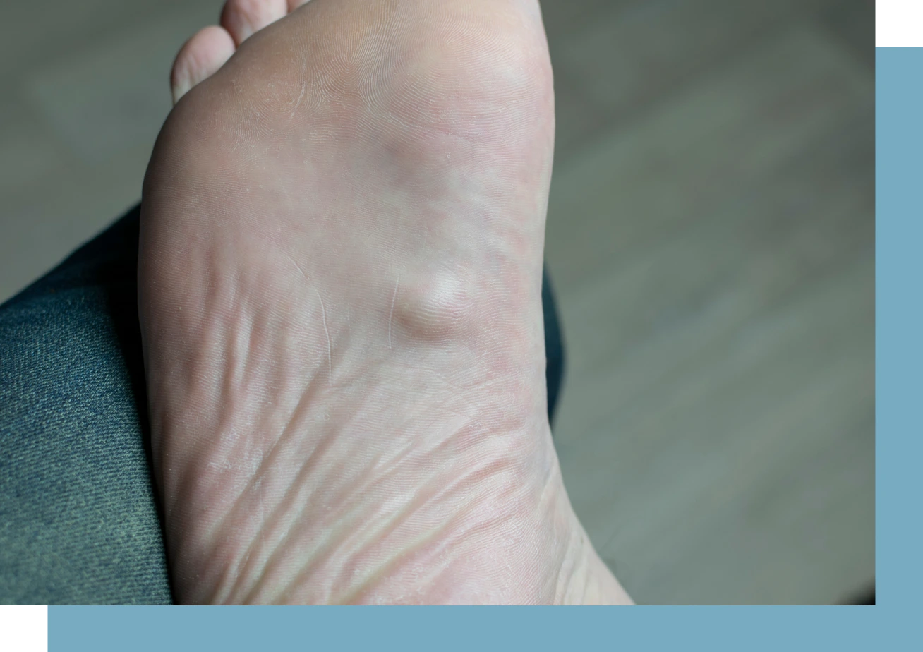 Ledderhose Disease Condition