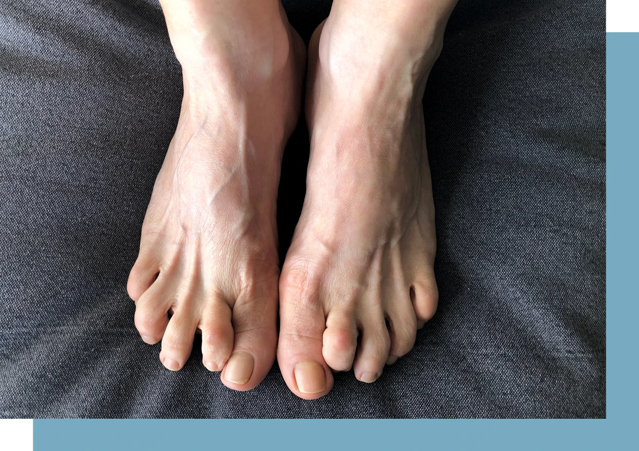 Hammertoe Condition