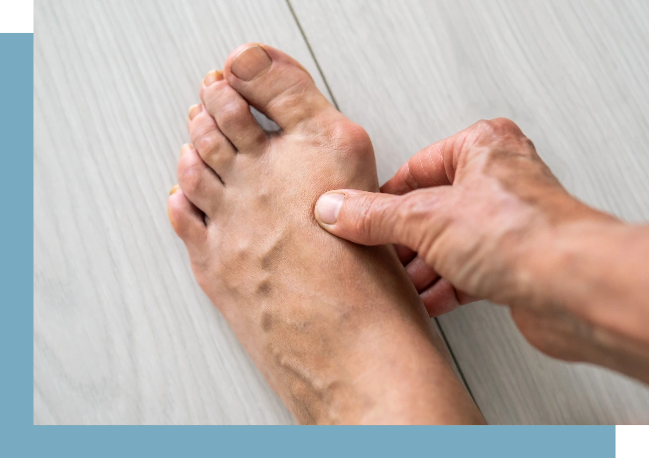 Bunion Surgery in NYC Banner