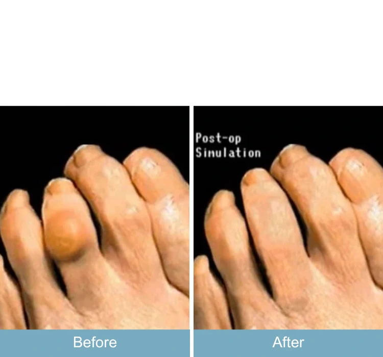 Hammertoe Deformity Treatment Before & After - Case 12