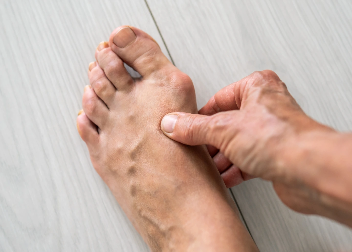What Is Bunion Deformity? Banner