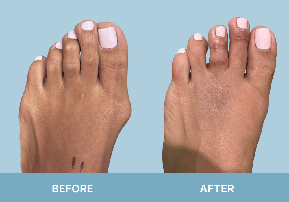 Before and after comparison of bunion deformity treatment showing reduced bunion prominence on right foot post-treatment