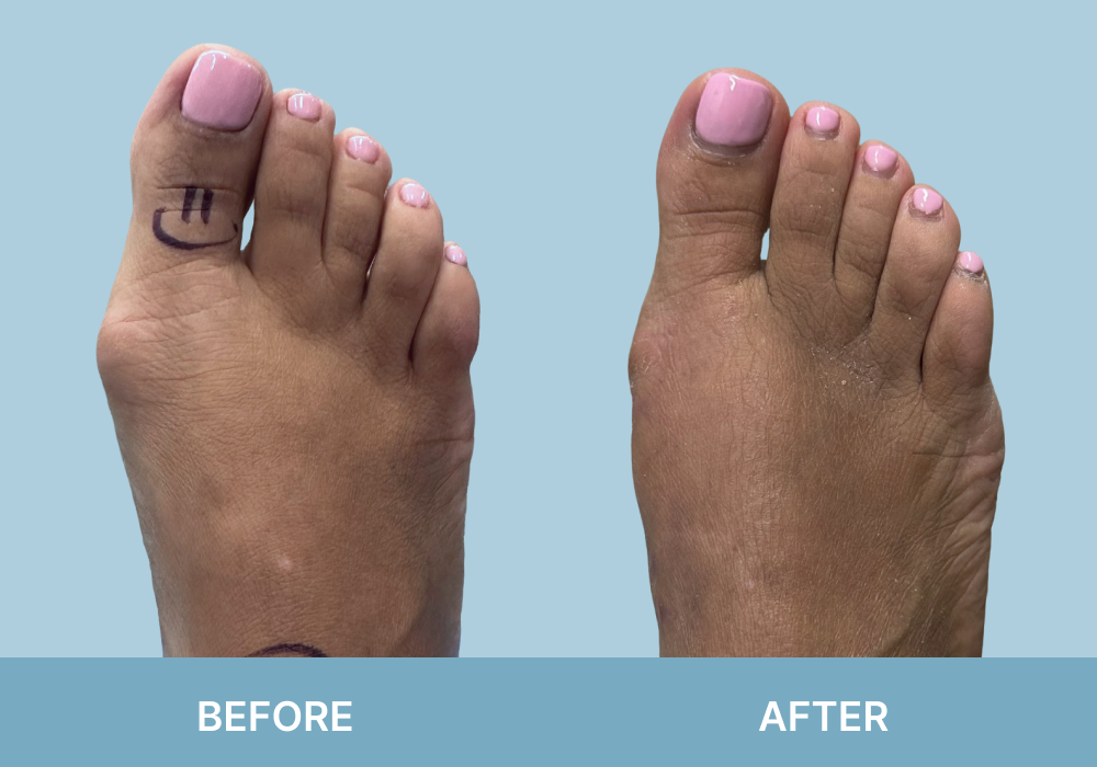 Before and after bunion surgery: left foot shows prominent bunion with surgical markings, right foot shows corrected alignment without bunion deformity