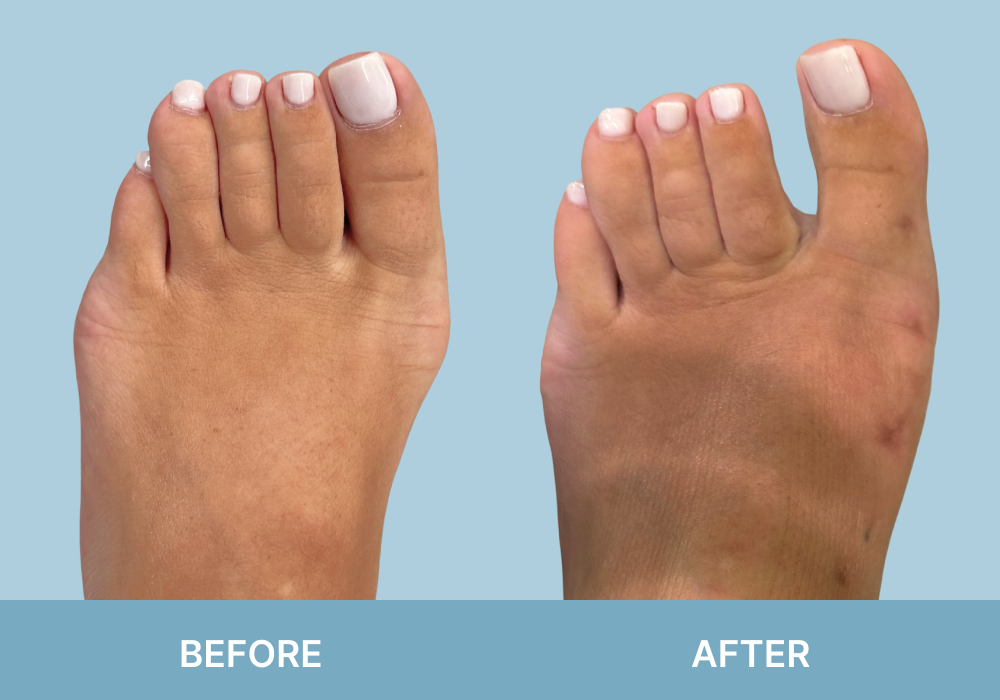 Before and after comparison of foot showing bunion deformity correction, with prominent bump on left foot resolved on right foot