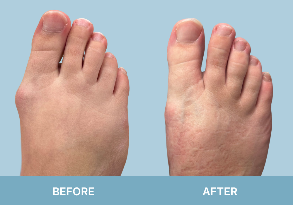 Before and after bunion treatment: left foot shows prominent bunion deformity at big toe joint; right foot shows corrected alignment with reduced bunion