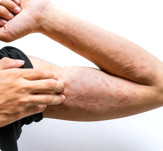 Eczema Treatment Procedure Banner