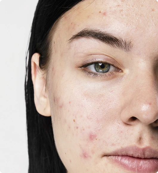 What is Acne Banner