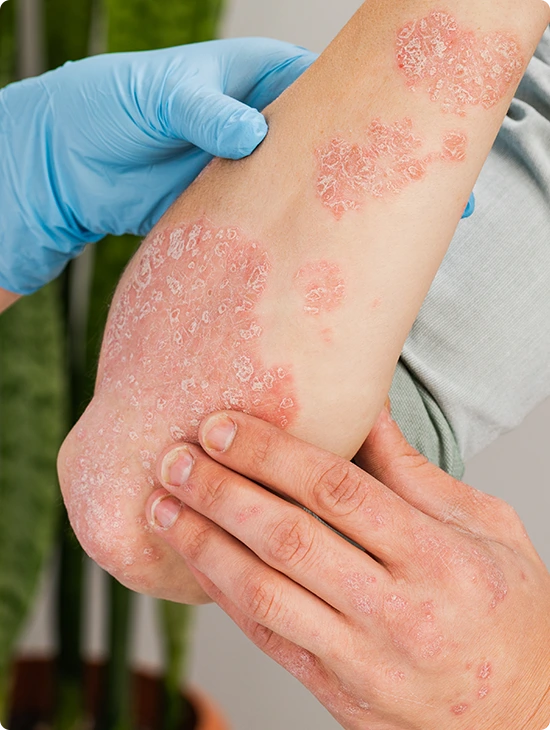 What is Eczema Banner