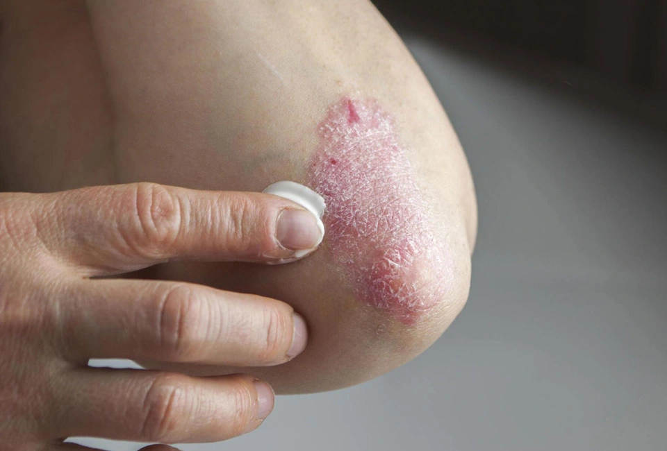 What is Psoriasis Banner