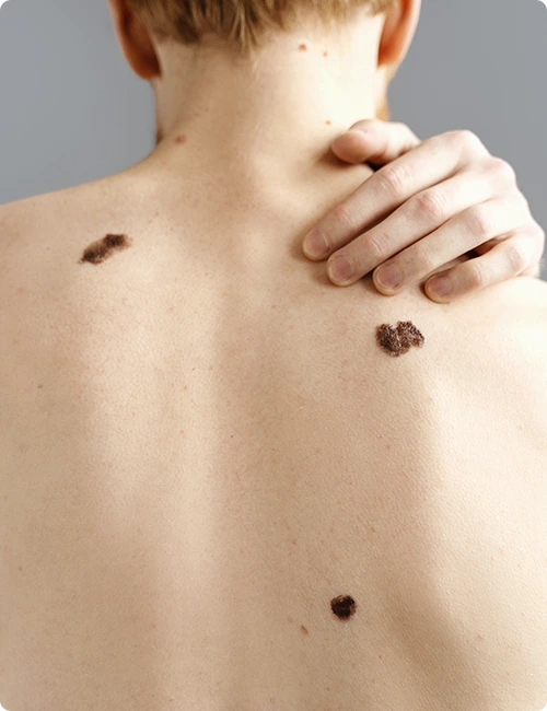 Candidate for melanoma treatment in Fresno, CA