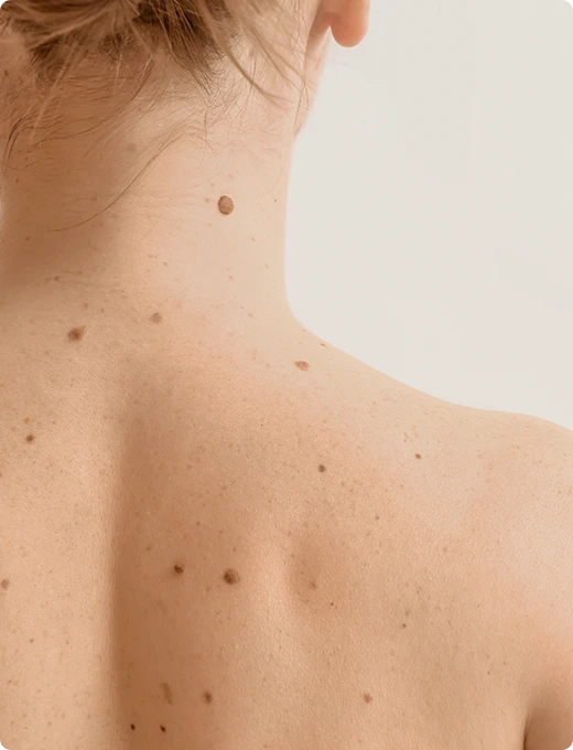 Early Melanoma Detection In Fresno, CA