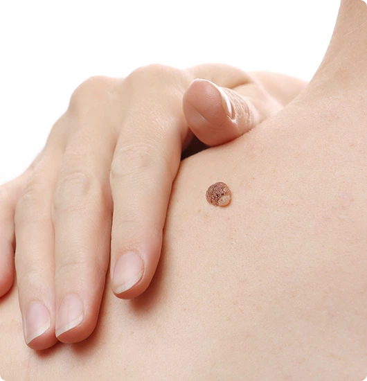 CANDIDATES FOR MOLE REMOVAL Banner