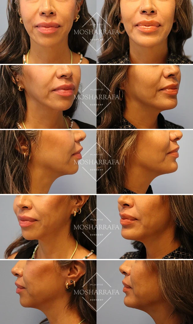 Chin augmentation before and after, Mosharrafa patient