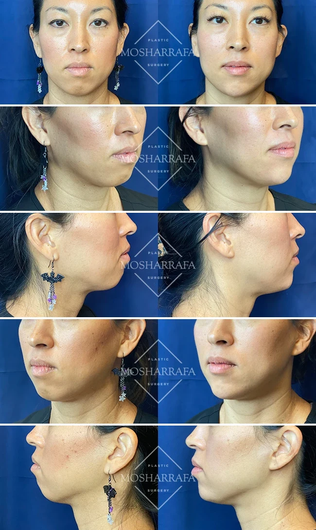 Chin filler before and after, Mosharrafa patient