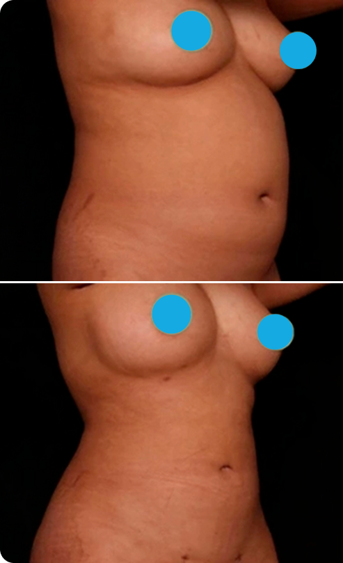 Liposuction Before and After A Banner