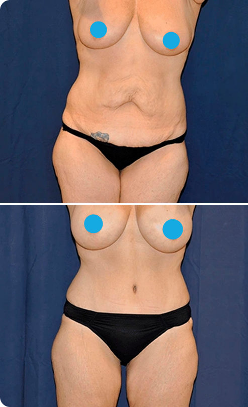 Liposuction Before and After B Banner