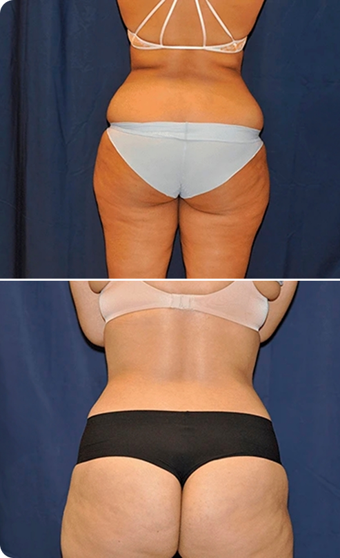 Liposuction Before and After C Banner