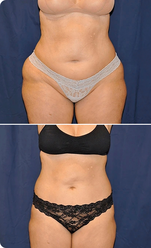 Liposuction Before and After D Banner
