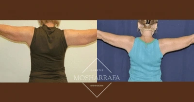 Patient demonstrating arm lift results with before and after comparison of upper arm contour