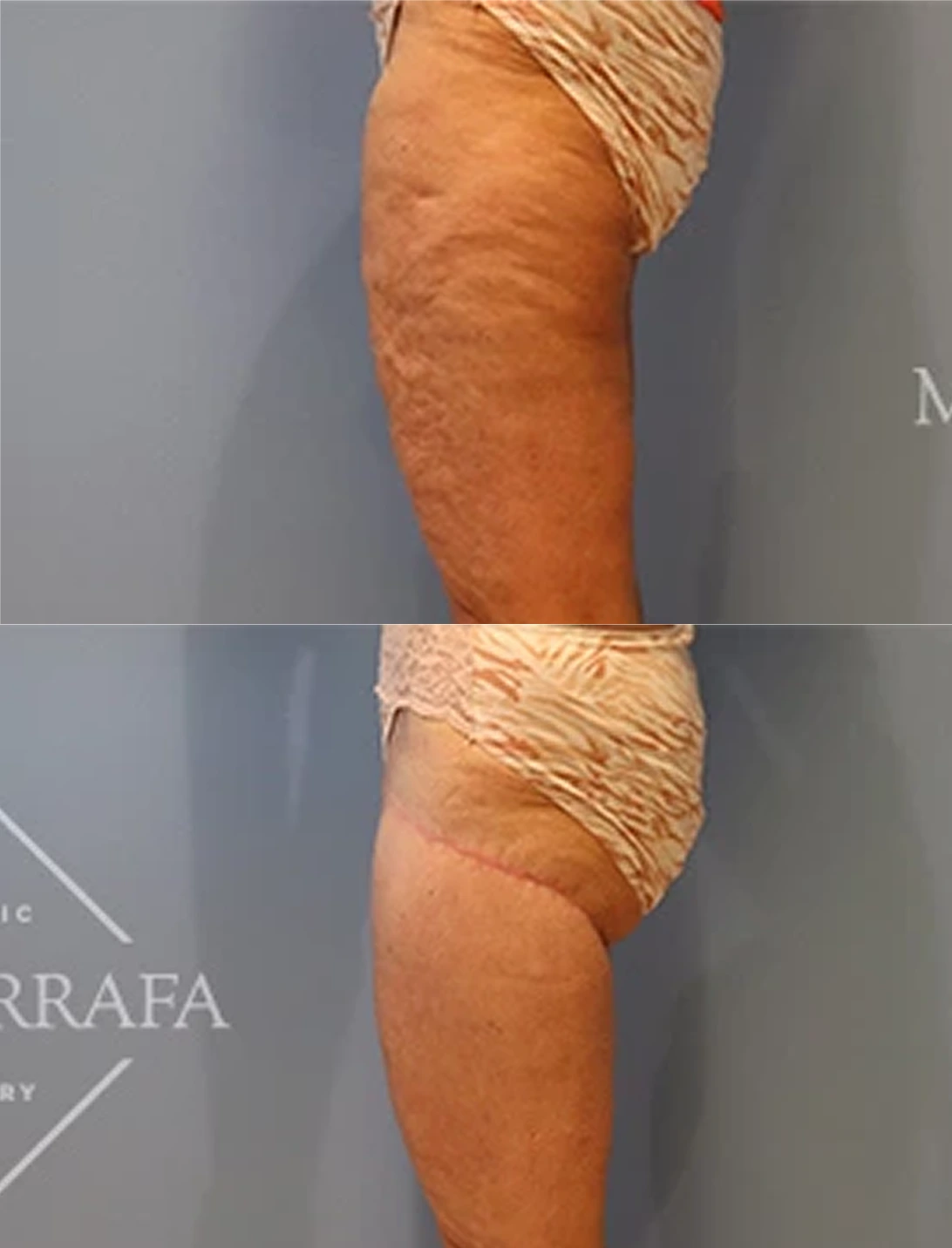 Thigh lift before-and-after comparison showing improved skin tightness and contour
