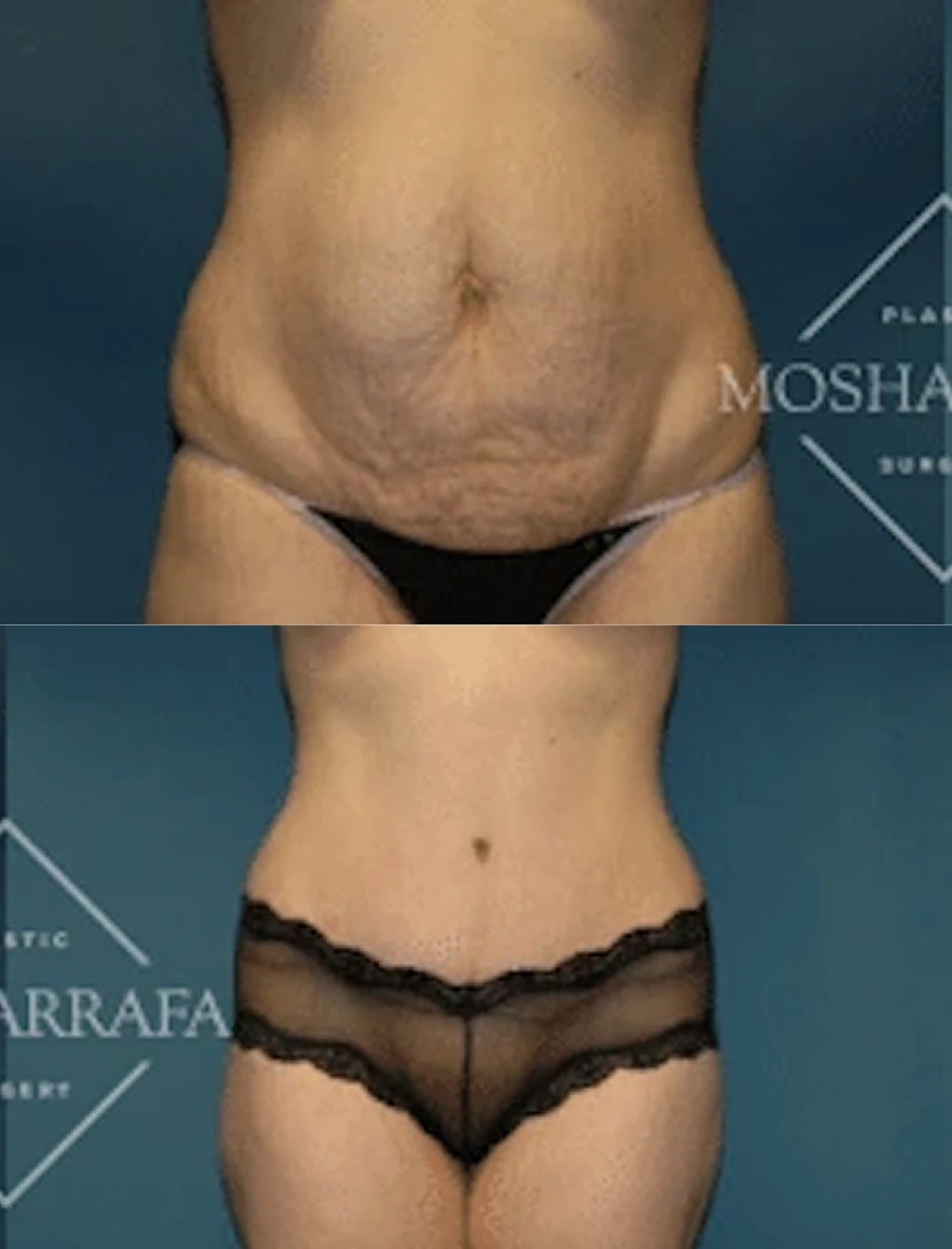 Before and after tummy tuck results showing reduced abdominal laxity and improved contour
