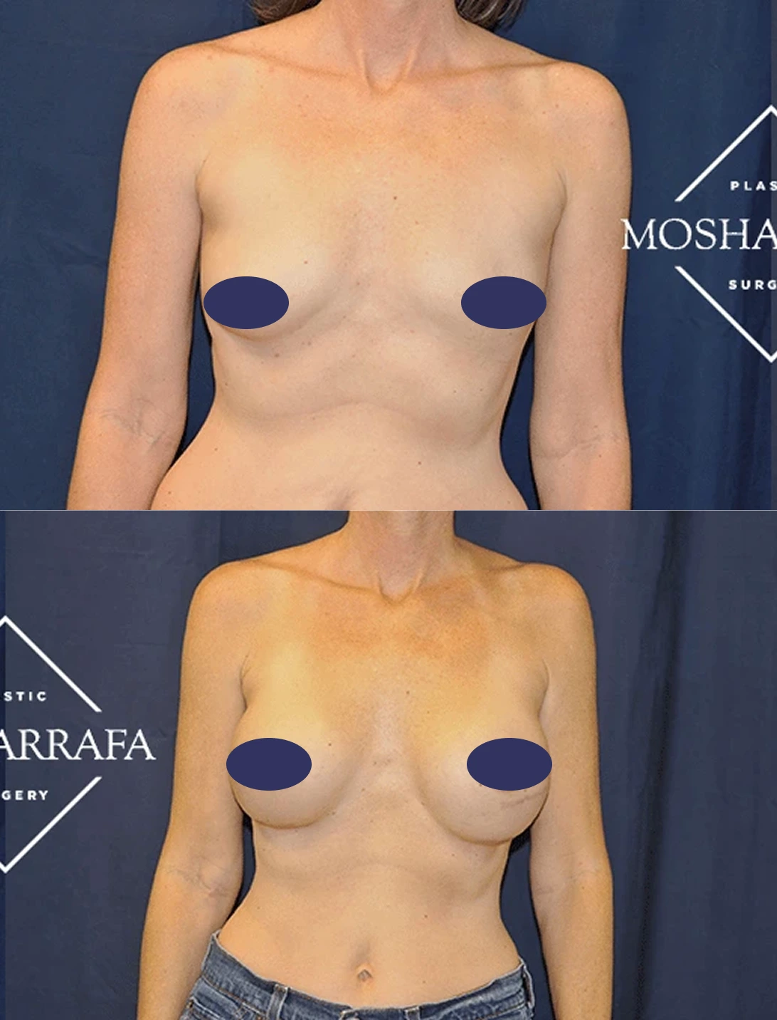 Breast augmentation before and after comparison showing frontal view with Mosharrafa Surgery branding