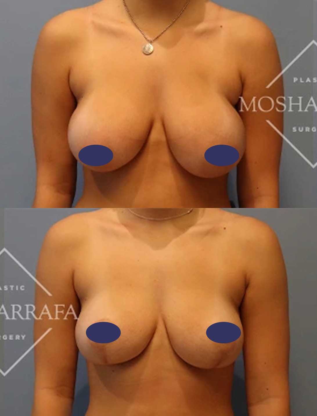 Breast reduction before and after comparison showing frontal view with modest coverage