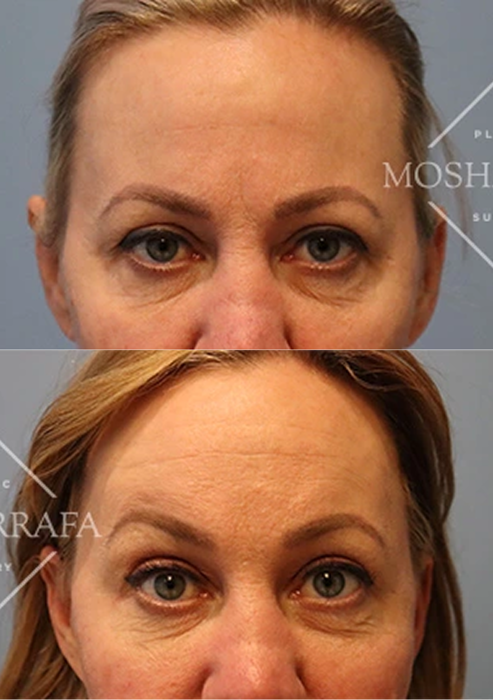 Before and after brow lift results showing elevated brows and reduced forehead wrinkles