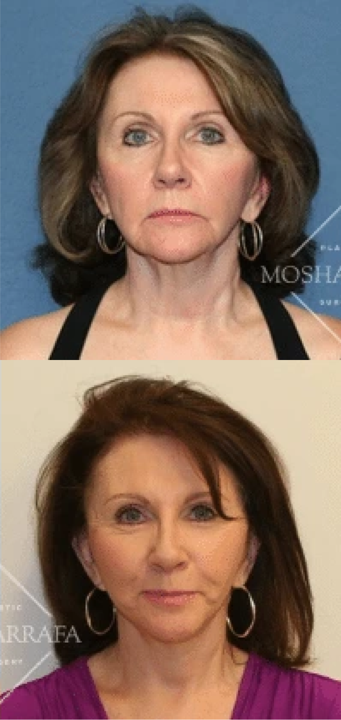 Facelift before and after comparison showing a patient's frontal face